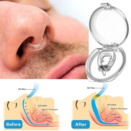 ANTI SNORING DEVICES