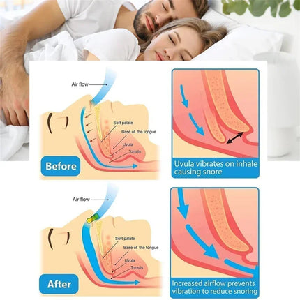 ANTI SNORING DEVICES