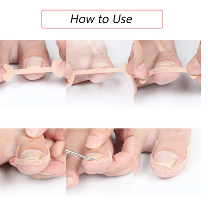 Toenail Correction Strips
