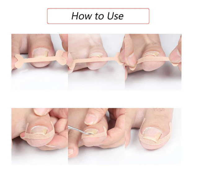 Toenail Correction Strips