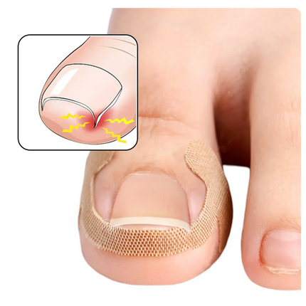 Toenail Correction Strips