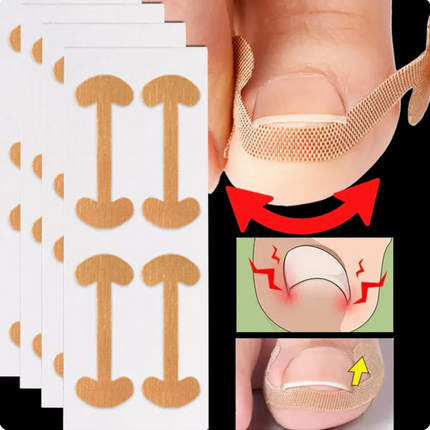 Toenail Correction Strips