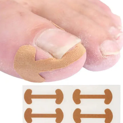 Toenail Correction Strips